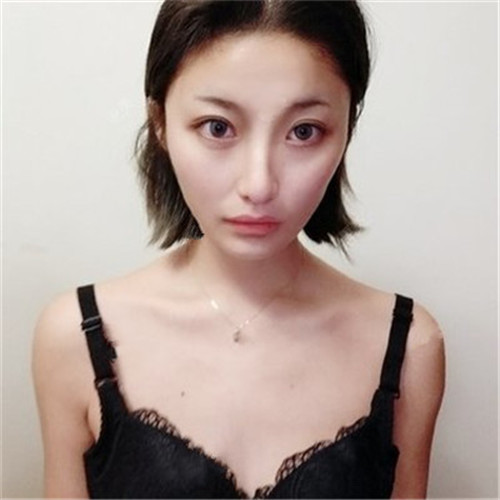 北京美莱曾昂隆胸怎么样?多少钱_案例_口碑