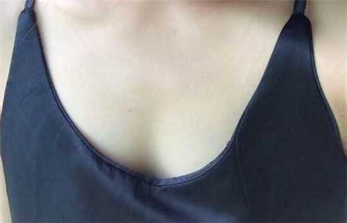北京叶子李明隆胸怎么样?多少钱_案例_口碑