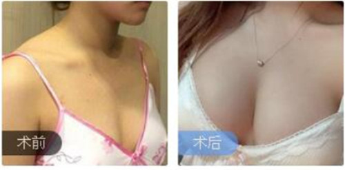 上海联合丽格李鸿君隆胸怎么样?多少钱_案例_口碑