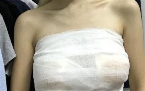 上海华美谢卫国隆胸怎么样?多少钱_案例_口碑