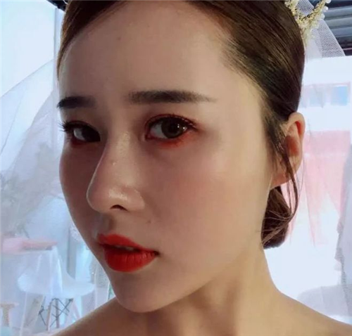 北京柏丽于海军隆鼻怎么样?多少钱_案例_口碑