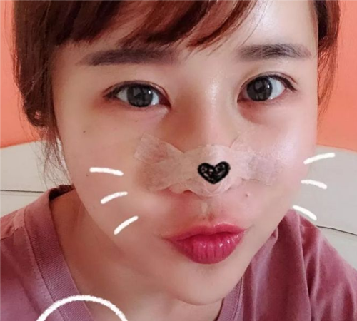 北京柏丽于海军隆鼻怎么样?多少钱_案例_口碑