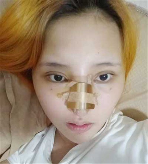 陈玉连隆鼻怎么样?多少钱_案例_口碑