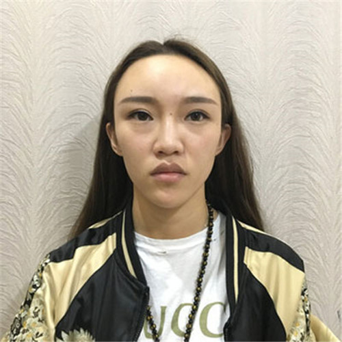 北京鼻祖赵连阁隆鼻怎么样?多少钱_案例_口碑