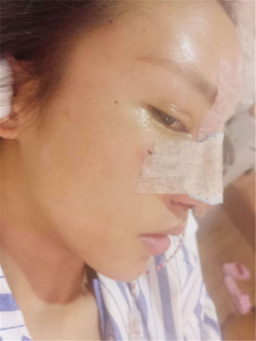 北京鼻祖赵连阁隆鼻怎么样?多少钱_案例_口碑