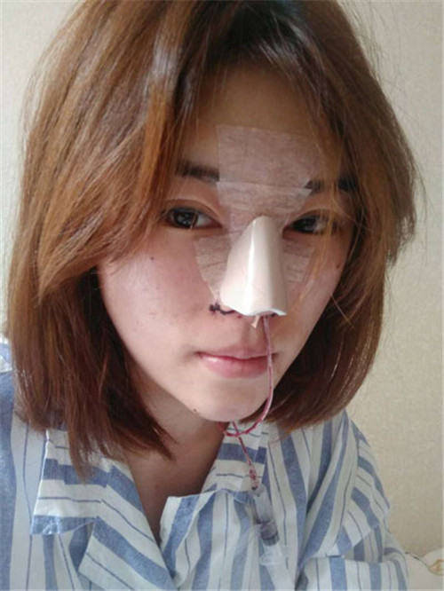 北京京民靳玉彪隆鼻怎么样?多少钱_案例_口碑