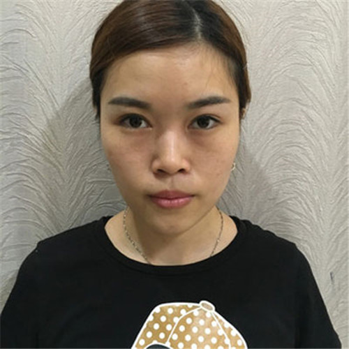 北京京民靳玉彪隆鼻怎么样?多少钱_案例_口碑