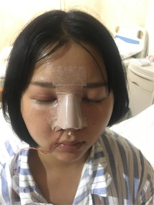 北京京民王志坚隆鼻怎么样?多少钱_案例_口碑
