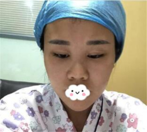 上海华美张朋隆鼻怎么样?多少钱_案例_口碑