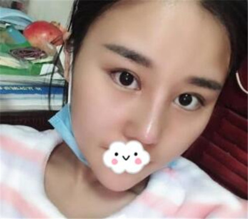 上海华美张朋隆鼻怎么样?多少钱_案例_口碑