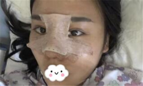上海华美张朋隆鼻怎么样?多少钱_案例_口碑