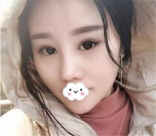 上海华美张朋隆鼻怎么样?多少钱_案例_口碑