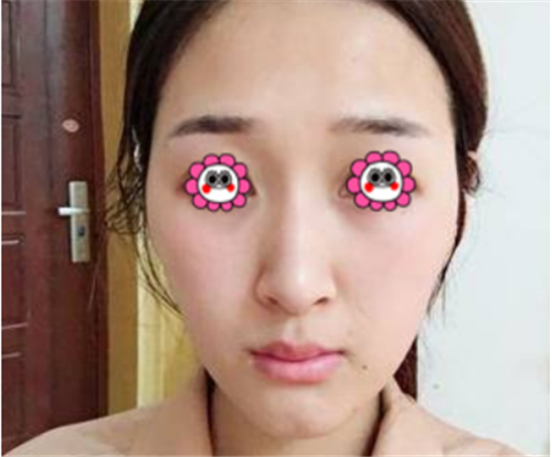 北京俊泰丽格薛志强隆鼻怎么样?多少钱_案例_口碑