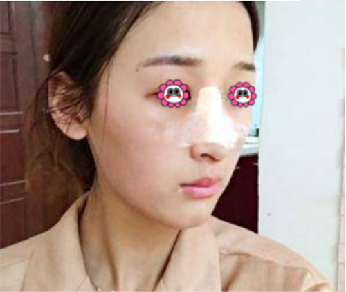 北京俊泰丽格薛志强隆鼻怎么样?多少钱_案例_口碑