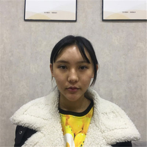 上海华美叶丽萍隆鼻怎么样?多少钱_案例_口碑