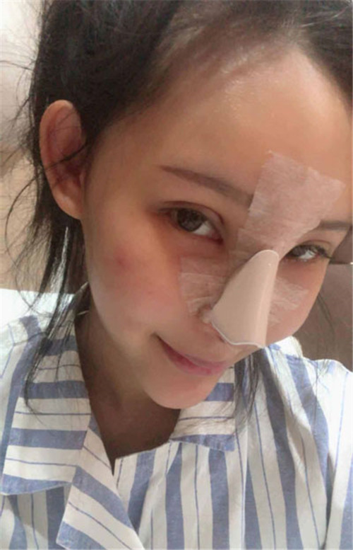 上海华美叶丽萍隆鼻怎么样?多少钱_案例_口碑