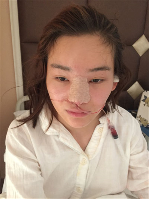 上海华美谢卫国隆鼻怎么样?多少钱_案例_口碑