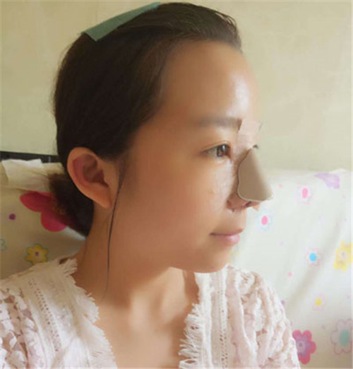 北京蕾士悦李海兵隆鼻怎么样?多少钱_案例_口碑