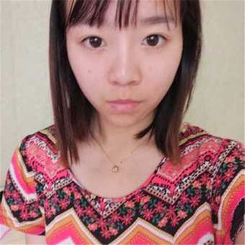 北京蕾士悦李海兵隆鼻怎么样?多少钱_案例_口碑