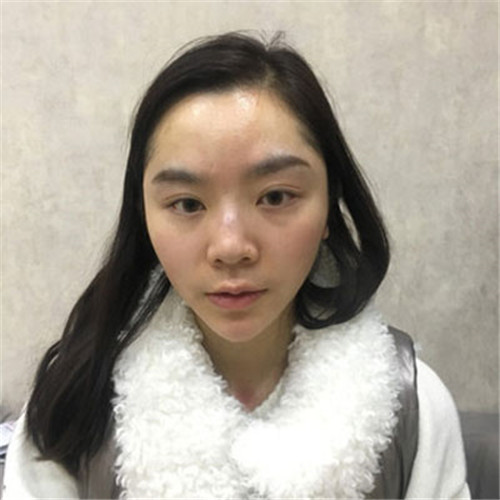 北京沃尔刘彦军隆鼻怎么样?多少钱_案例_口碑