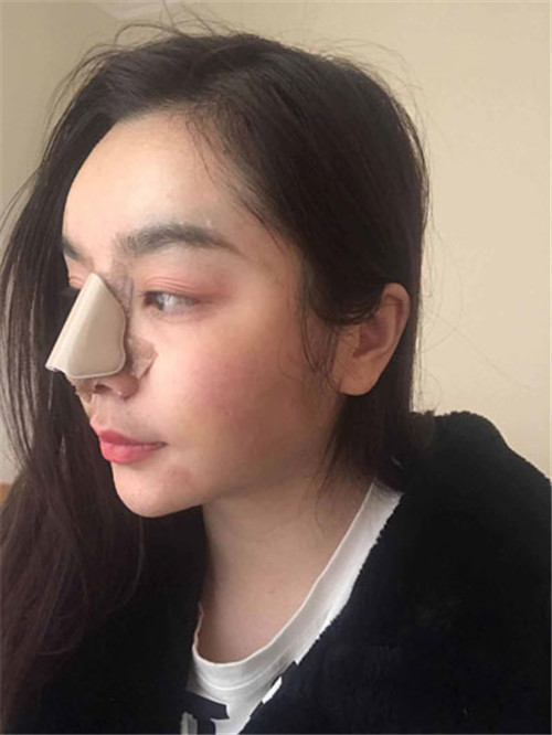 北京沃尔刘彦军隆鼻怎么样?多少钱_案例_口碑