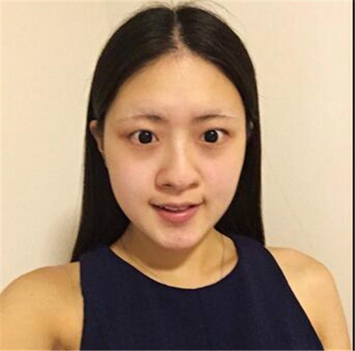 北京沃尔隆鼻怎么样?多少钱_案例_口碑