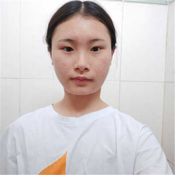 北京艺美王东抽脂术后果怎么样?案例,价格,口碑
