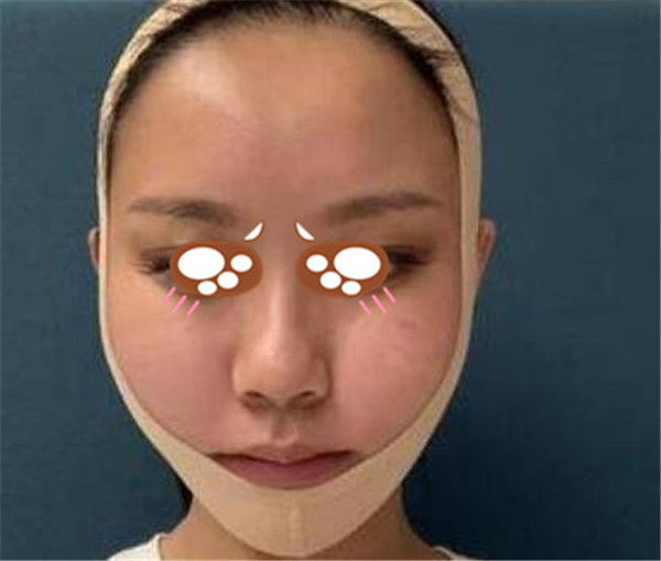 上海华美李健抽脂术后果怎么样?案例,价格,口碑