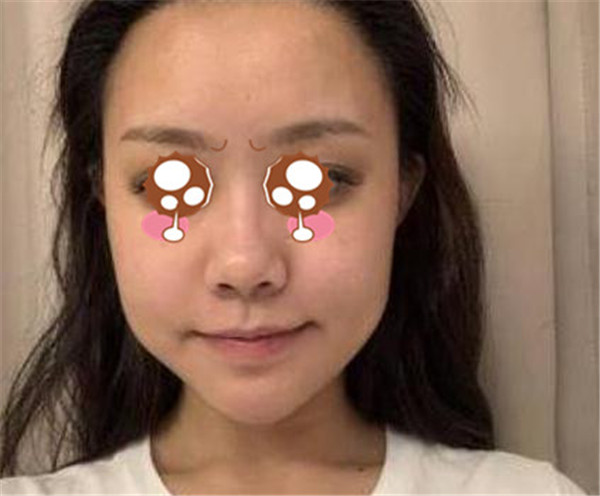上海华美李健抽脂术后果怎么样?案例,价格,口碑
