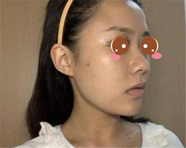 上海华美李健抽脂术后果怎么样?案例,价格,口碑