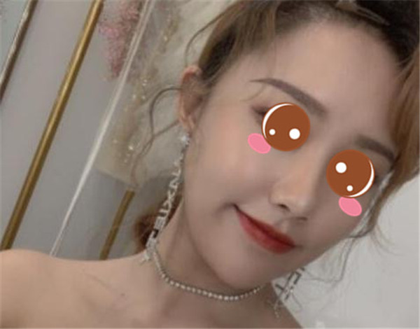 上海华美李健抽脂术后果怎么样?案例,价格,口碑