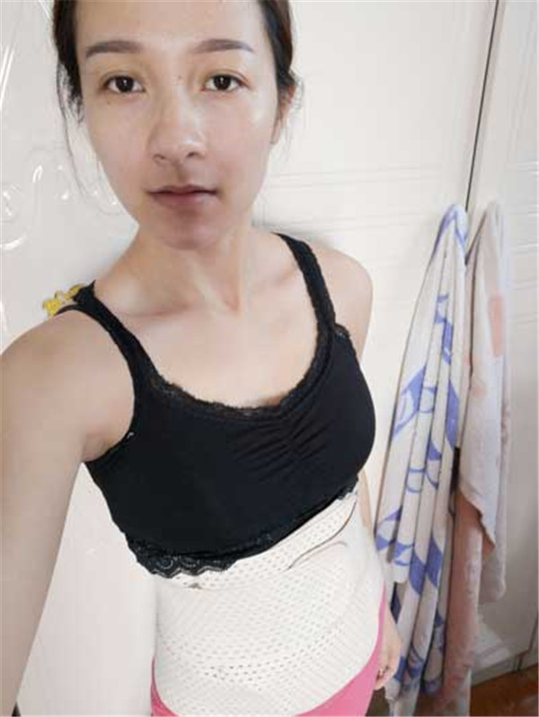 北京伟力嘉美信叶文珏抽脂术后果怎么样?案例,价格,口碑