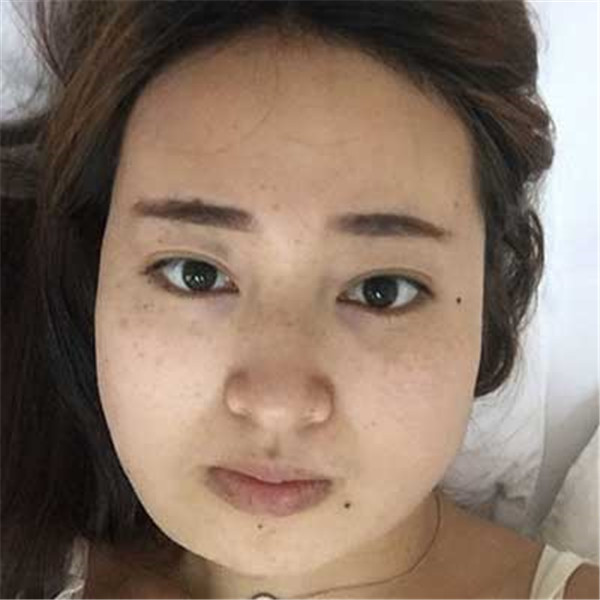 北京禾美嘉韦辉抽脂术后果怎么样?案例,价格,口碑