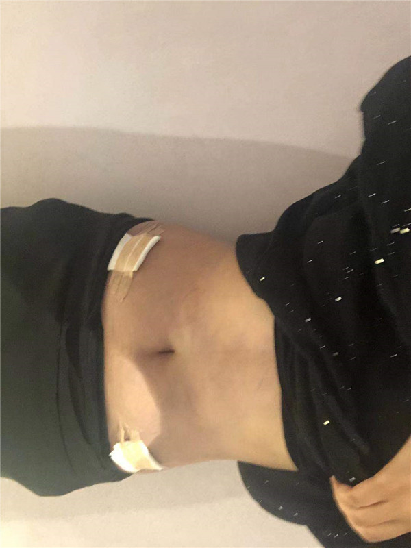 上海华美张朋抽脂术后果怎么样?案例,价格,口碑