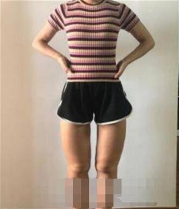上海薇琳曹芳抽脂术后果怎么样?案例,价格,口碑