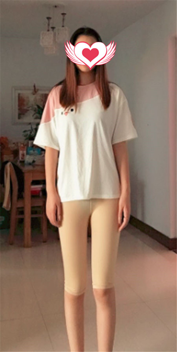 袁玉坤抽脂术后果怎么样?案例_价格_口碑