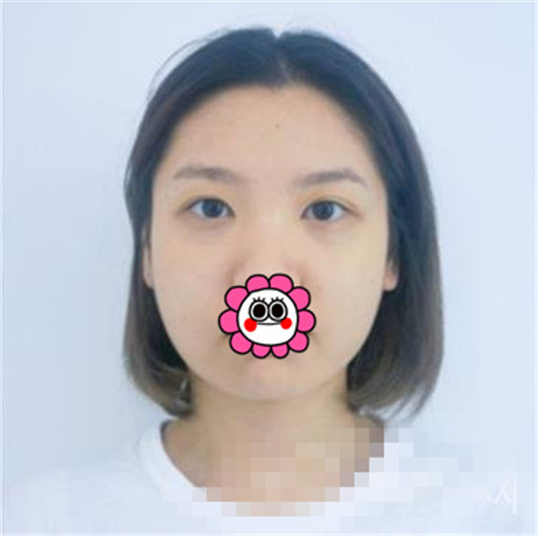 上海华美叶丽萍抽脂术后果怎么样?案例,价格,口碑