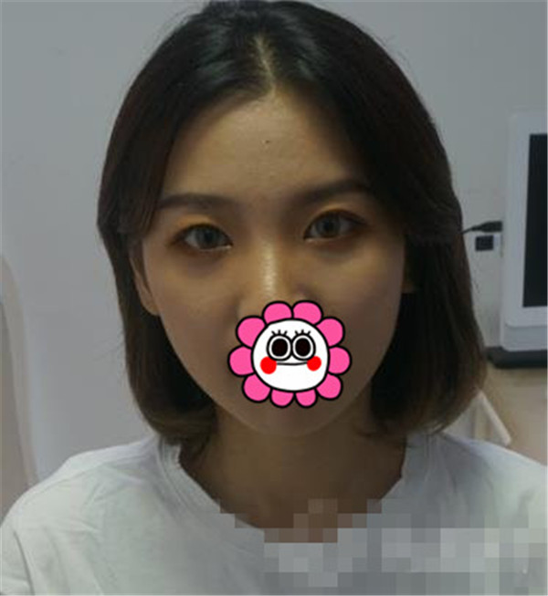 上海华美叶丽萍抽脂术后果怎么样?案例,价格,口碑