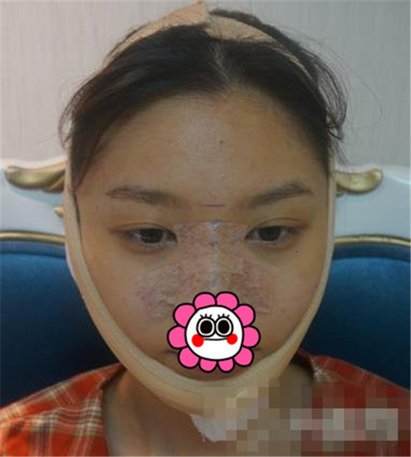 上海华美叶丽萍抽脂术后果怎么样?案例,价格,口碑