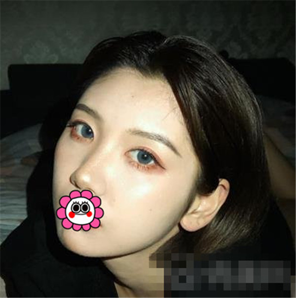 上海华美叶丽萍抽脂术后果怎么样?案例,价格,口碑