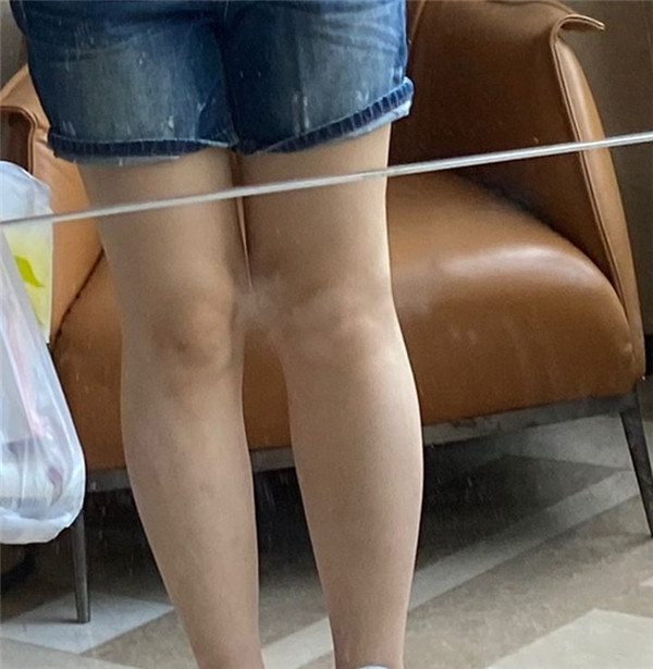 北京禾美嘉任学会抽脂术后果怎么样?案例,价格,口碑
