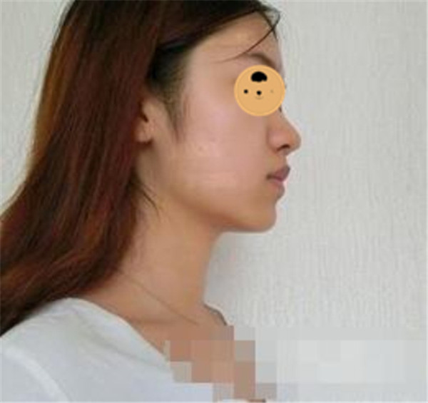 上海华美何斌抽脂术后果怎么样?案例,价格,口碑