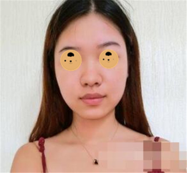 上海华美何斌抽脂术后果怎么样?案例,价格,口碑