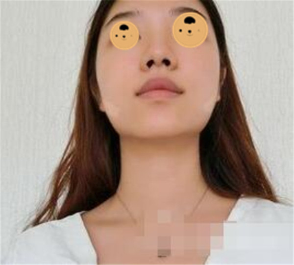 上海华美何斌抽脂术后果怎么样?案例,价格,口碑