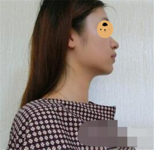上海华美何斌抽脂术后果怎么样?案例,价格,口碑