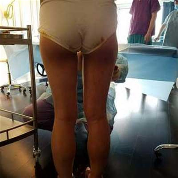 北京禾美嘉任学会抽脂术后果怎么样?案例_价格_