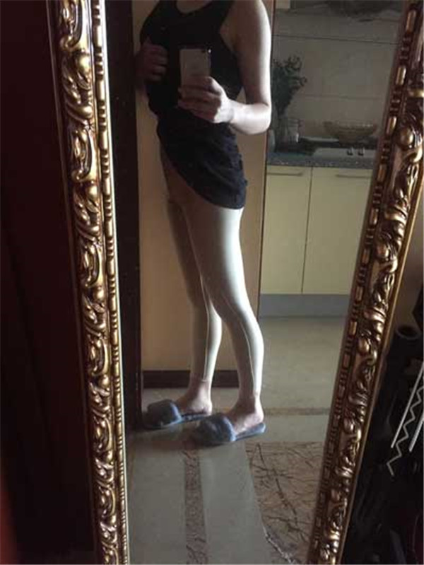 北京禾美嘉任学会抽脂术后果怎么样?案例_价格_