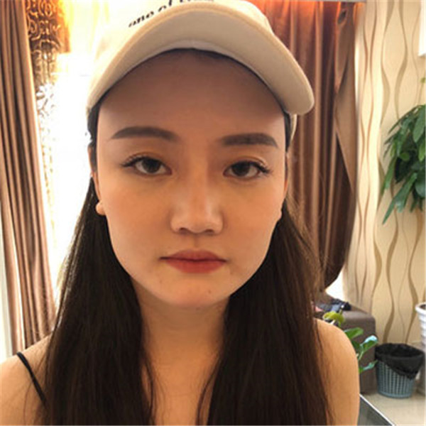 孙海如抽脂术后果怎么样?案例,价格,口碑