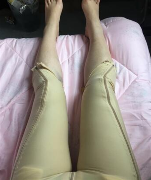 北京玉之光王明利抽脂术后果怎么样?案例,价格,口碑