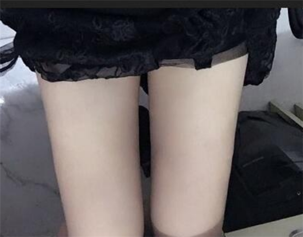北京玉之光王明利抽脂术后果怎么样?案例,价格,口碑